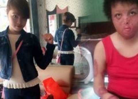 Nỗi đau người vợ trẻ bị chồng tẩm xăng thiêu sống khiến mặt biến dạng