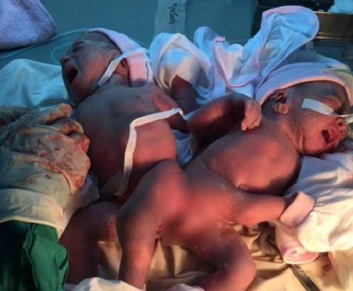 Xót thương hai bé gái song sinh dính liền mông, không có hậu môn