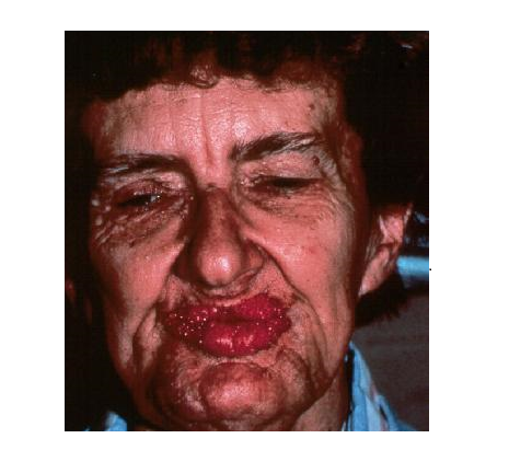 Những căn bệnh kỳ quặc nhất lịch sử: Tự ăn thịt chính mình