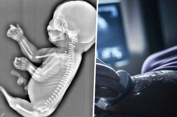 Thai phụ phát hoảng vì mang bầu 'người cá'