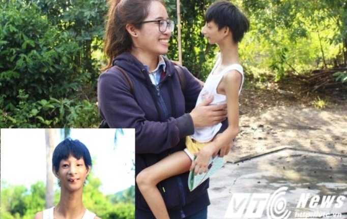 Cậu bé 'người chim' 14 tuổi chỉ nặng 7kg, cao chưa đến 1m ở Huế