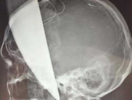 Bệnh viện Việt Đức phẫu thuật lấy dao bầu cắm xuyên não bệnh nhân