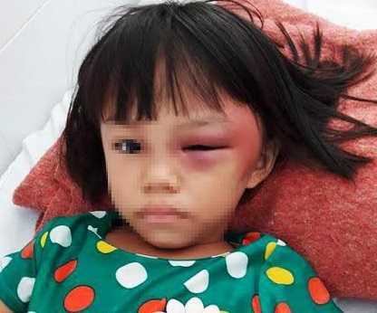 Bé gái 7 tuổi bị mẹ kế đánh sưng mắt, châm thuốc lá bỏng tay