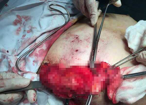 Bơm silicon dạo, người phụ nữ phải cắt bỏ toàn bộ tuyến vú