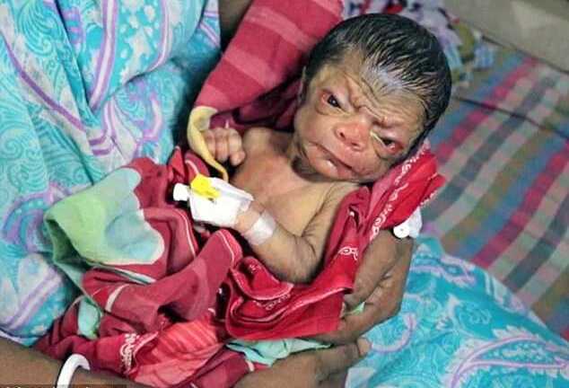 Bệnh cực hiếm khiến bé sơ sinh già nhăn nheo như ông lão 80