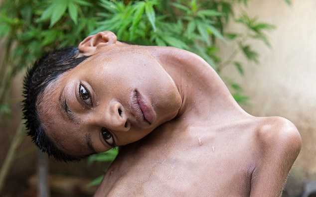 Cậu bé có chiếc cổ kỳ lạ ở Ấn Độ