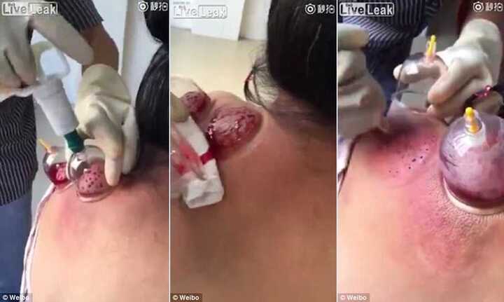 Ớn lạnh cảnh bác sĩ đâm thủng da, hút máu bệnh nhân để chữa bệnh