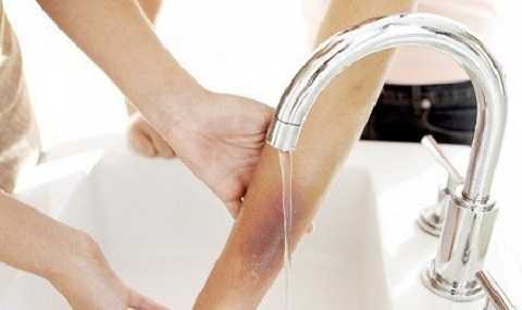 Sai lầm khi chữa bỏng: Việc làm nhỏ, hậu quả lớn