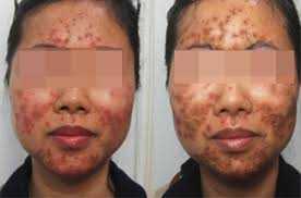 'Cấy phấn' lên mặt để làm đẹp: Coi chừng hoại tử da