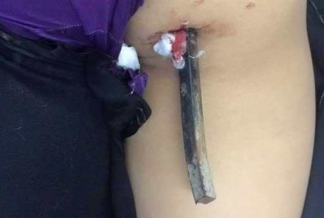 Tin mới sức khỏe nữ sinh 15 tuổi bị thanh sắt đâm xuyên người