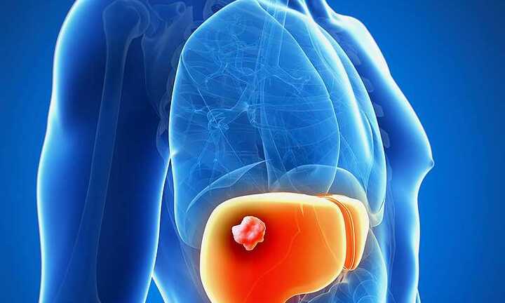 Thấy triệu chứng khó ngờ này ở vùng bụng, nguy cơ ung thư gan