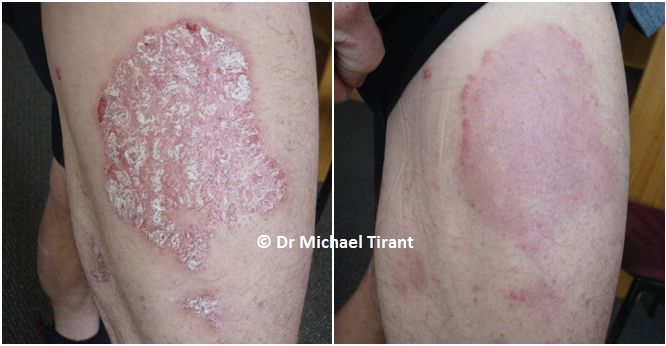 Nghiên cứu mở trung tâm về sản phẩm Dr Michaels® thảo dược trong điều trị bệnh vảy nến