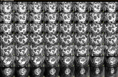 Nữ bệnh nhân có tới 30 khối u nằm chi chít trong tử cung