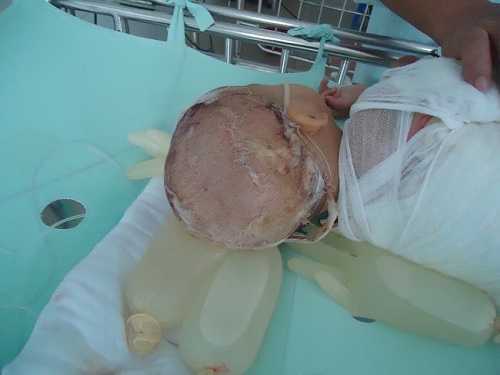 Tội nghiệp bé 17 tháng tuổi ngã vào nồi canh đang nguy kịch