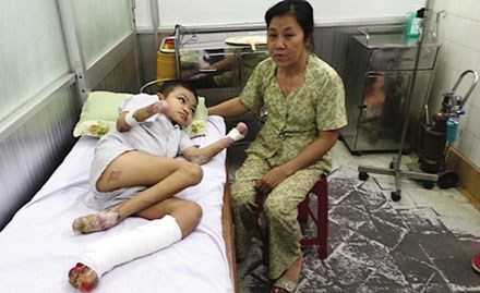 Khủng khiếp với căn bệnh lạ vừa phát hiện tại Việt Nam gặm nhấm rụng tay chân