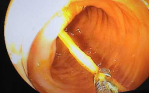 Bé trai 14 tuổi nuốt phải tăm nhọn bị đâm xuyên thành ruột