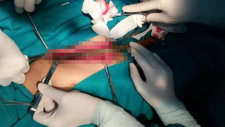 Bé trai 9 tuổi bị cành nhãn đâm xuyên 'của quý'