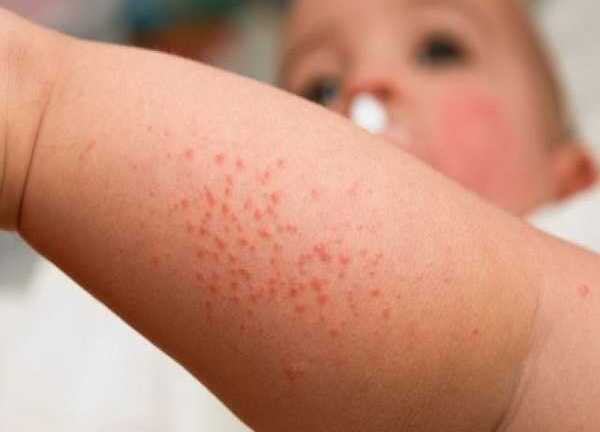 Hà Nội: Nhiều trẻ nhập viện vì sốt xuất huyết