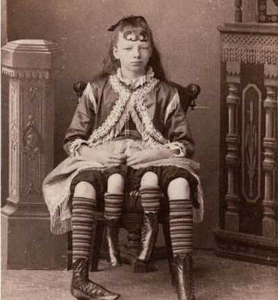 Hội chứng hiếm gặp: Người đàn bà 4 chân khiến y học chưa thể lý giải