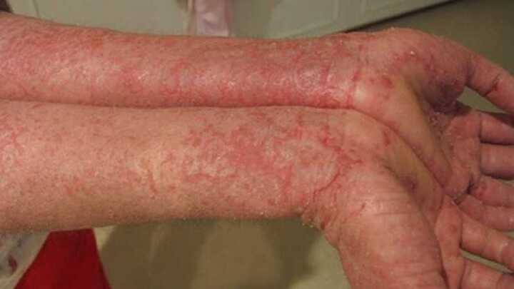 Cách điều trị bốn dạng viêm da tấn công mùa hanh khô