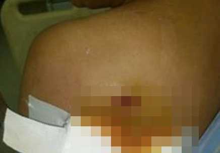 Đi dự đám ma, một phụ nữ bị đạn găm vào lưng