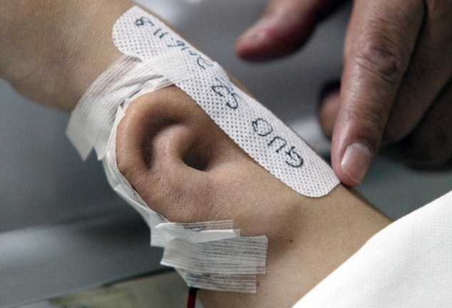 Bác sĩ Trung Quốc 'trồng' tai giả trên cánh tay bệnh nhân