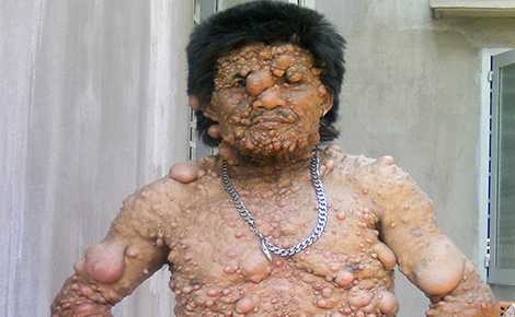 Đời buồn thảm của 'người cóc' Tây Nguyên khiến ai cũng phải sợ hãi