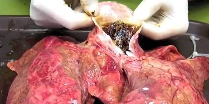 Bao nhiêu người còn dám hút thuốc sau khi xem video này?