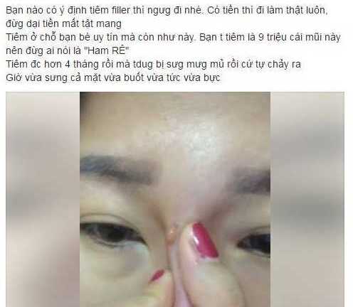 Hotgirl tung clip 'tai biến phẫu thuật' sau tiêm filler nâng mũi khiến cộng đồng mạng xôn xao