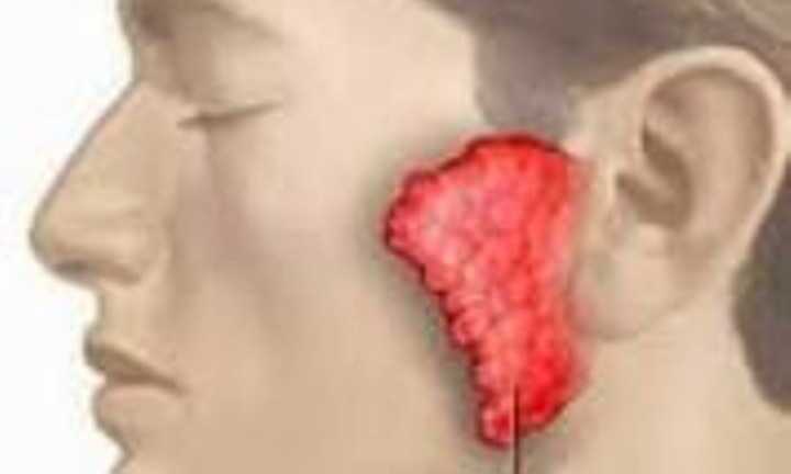 Bệnh quai bị có thể dẫn đến vô sinh như thế nào?