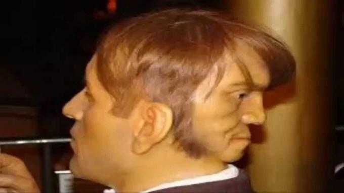 Bí ẩn về những người đàn ông hai mặt khiến y học bối rối