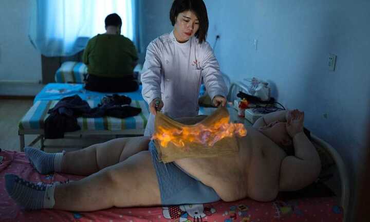 Rùng mình cảnh châm lửa đốt cháy mỡ bụng cho người béo phì