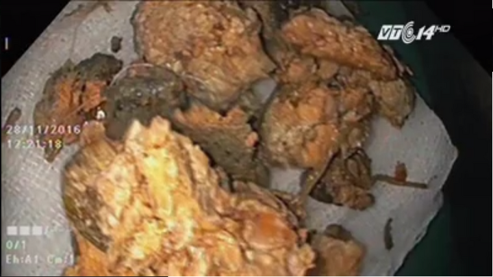 Ăn quá nhiều hồng giòn lúc đói, bị tắc ruột phải nhập viện cấp cứu