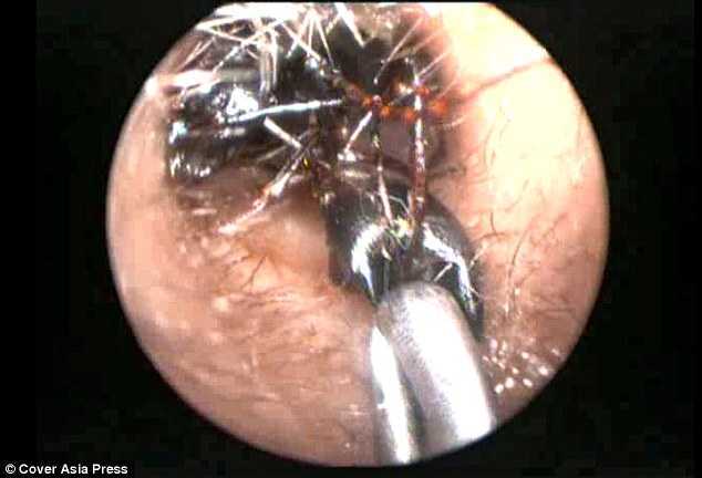 Hơn 1.000 con kiến làm tổ trong tai bé gái 12 tuổi