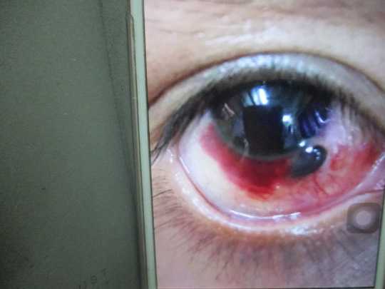 'Dzô' quá sung, ly bia vỡ bắn thủng mống mắt