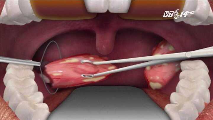 Cắt amidan nguy hiểm như thế nào?