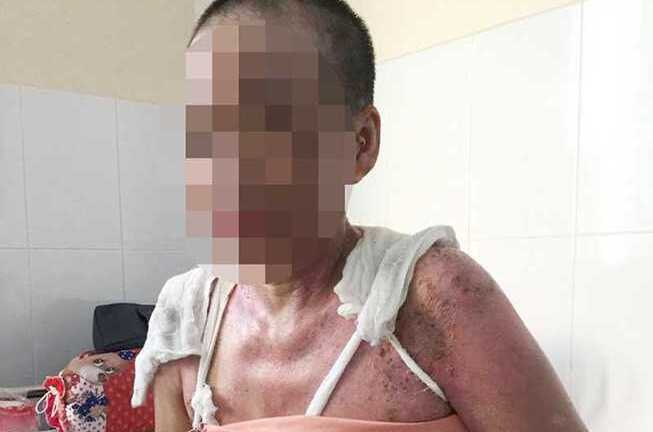 Từ chối móc cống, nhân viên quán cơm bị tạt cả nồi thịt sôi vào người