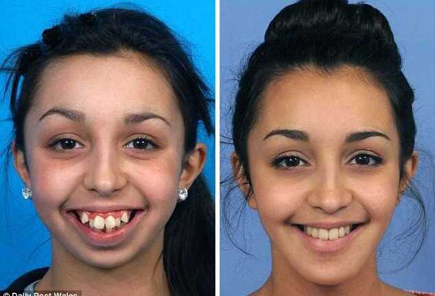 Cô gái 'vịt hóa thiên nga' tự tin tham gia Miss Wales