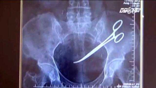 Vì sao kéo nằm trong ổ bụng 18 năm mà bệnh nhân không biết?