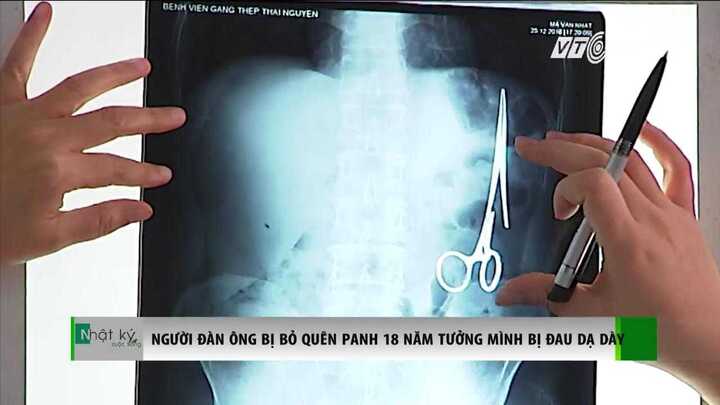 Bác sỹ quên panh dài 20cm trong bụng 18 năm, bệnh nhân tưởng đau dạ dày