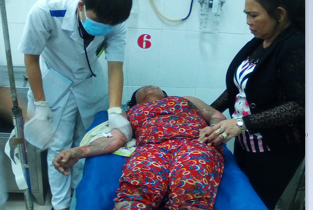 Bật bếp gas nấu nước tắm buổi tối, 1 phụ nữ nguy kịch