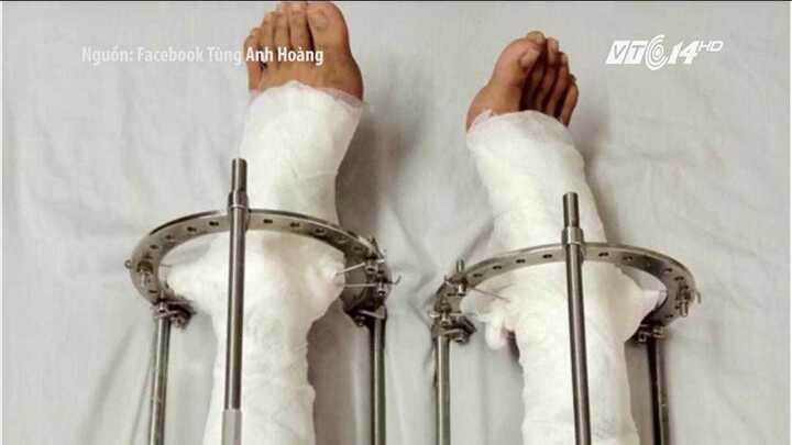 5 năm chịu đau đớn kéo dài chân, chàng trai Hà Nội cao thêm 10cm