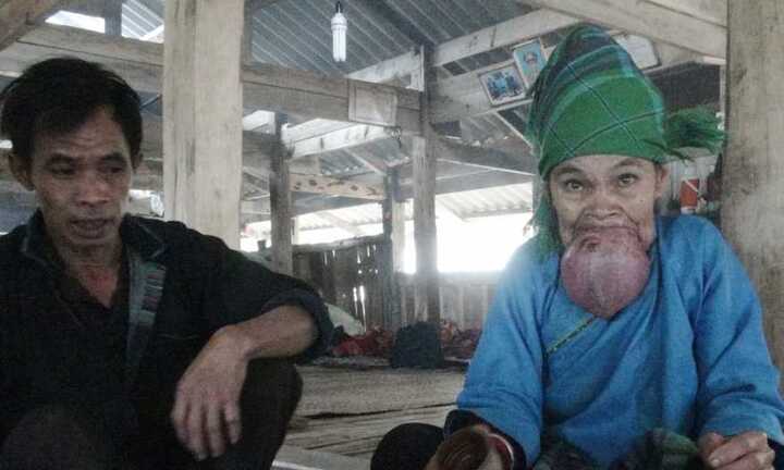 Xót xa nhìn cụ bà ở Hà Giang khổ sở vì chiếc lưỡi khổng lồ