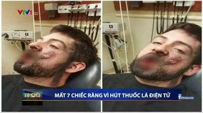 Thuốc lá điện tử phát nổ trong miệng, người đàn ông mất 7 cái răng, bỏng nặng
