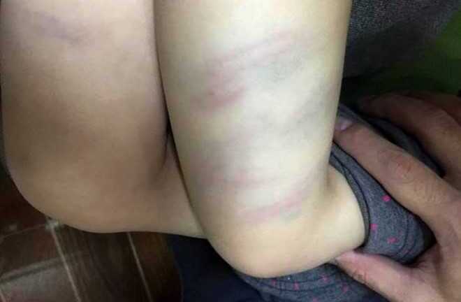 Thanh Hóa: Cô giáo mầm non dùng đũa đánh bé 2 tuổi bầm tím