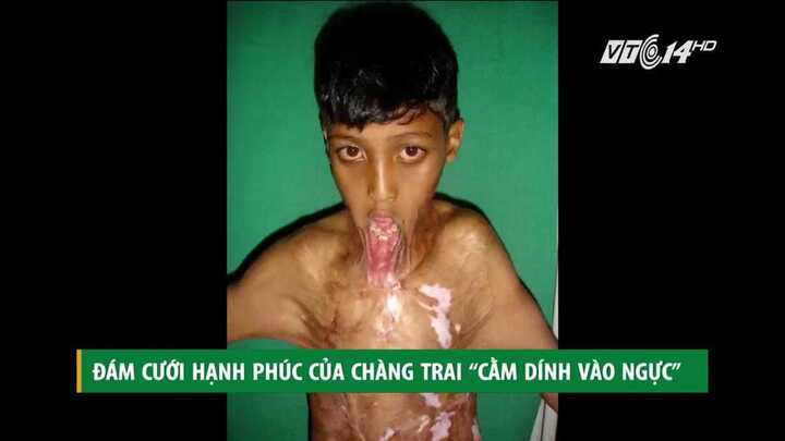 Đám cưới hạnh phúc của chàng trai 'cằm dính vào ngực'