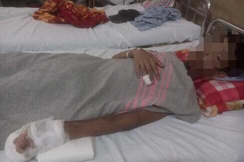 Nghịch pháo tự chế, nam thiếu niên bị hỏng mắt