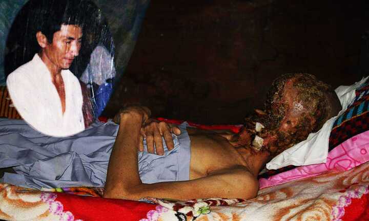 Người đàn ông mắc bệnh lạ bị ăn hết khuôn mặt từng giấu mình 5 năm và có ý định tự tử