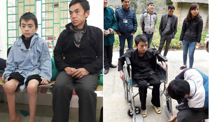 Nhói lòng cậu bé người Mông mất đi đôi chân vì căn bệnh máu không đông