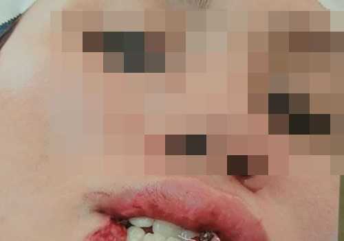 Cô ruột cắn cháu gái đứt lìa 1/3 môi dưới